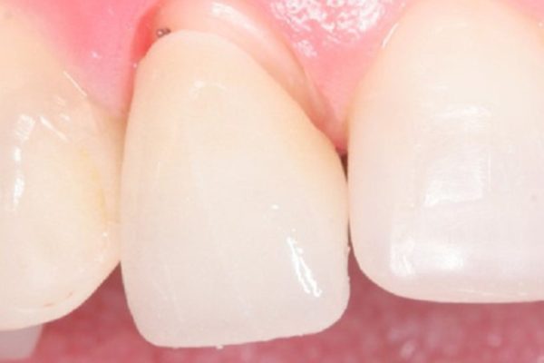 Bọc răng sứ có tháo ra được không? Cần làm lại trong trường hợp nào?