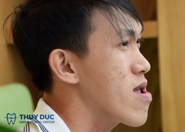 Mặt lưỡi cày là tướng tốt hay xấu? Khắc phục được không? - Nha Khoa Thúy Đức