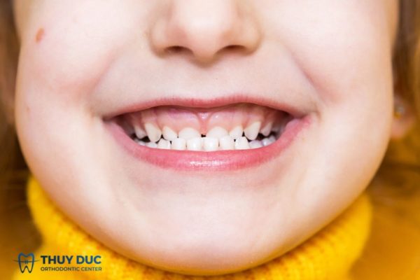 Khớp cắn ngược ở trẻ nhỏ – dấu hiệu và biện pháp can thiệp
