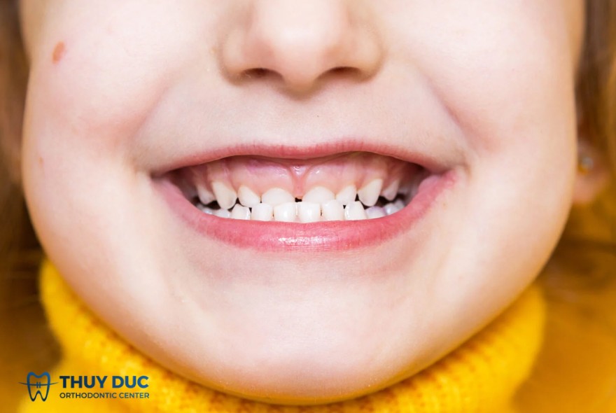 Điều trị khớp cắn ngược ở trẻ nhỏ như thế nào?
