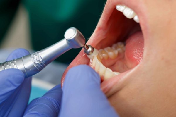 Lấy cao răng ở trẻ – khi nào thích hợp và khác gì ở người lớn?