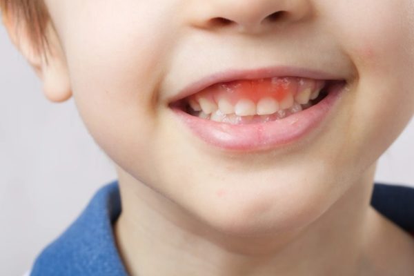 Tìm hiểu các bệnh răng bệng phổ biến ở trẻ em