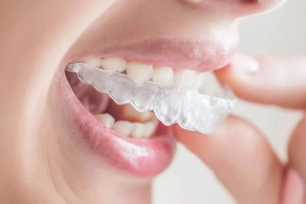 Tổng hợp các loại niềng răng trong suốt phổ biến nhất hiện nay Tổng hợp các loại niềng răng trong suốt phổ biến nhất hiện nay