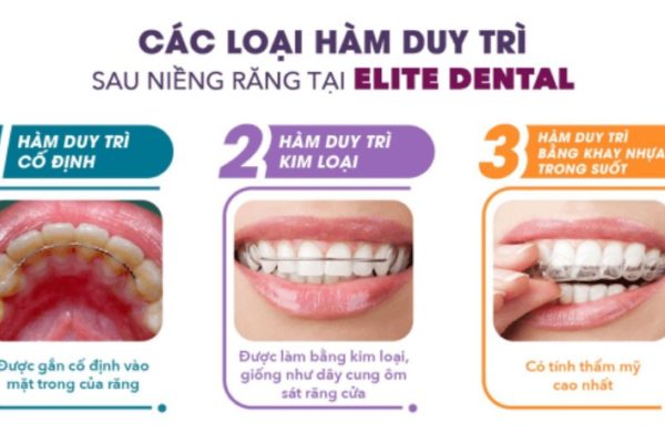 Vì sao phải đeo hàm duy trì sau chỉnh nha? Các loại hàm duy trì khi niềng răng