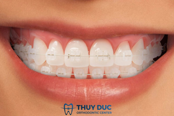 Ưu điểm vượt trội của mắc cài sứ tự buộc damon clear 2