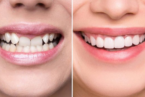 Bị móm răng thì bọc răng sứ có khắc phục được không?