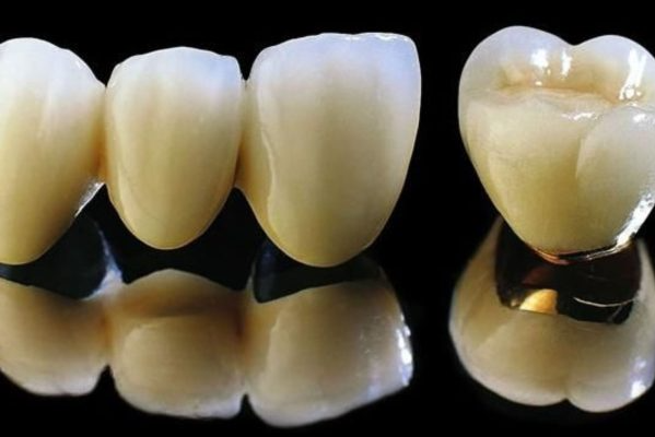 Bọc răng sứ cho răng hàm thì dùng loại nào tốt?