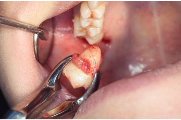 Nhổ răng số 7 có nguy hiểm không? – Giải đáp của chuyên gia. Nhổ răng số 7 có nguy hiểm không? – Giải đáp của chuyên gia.