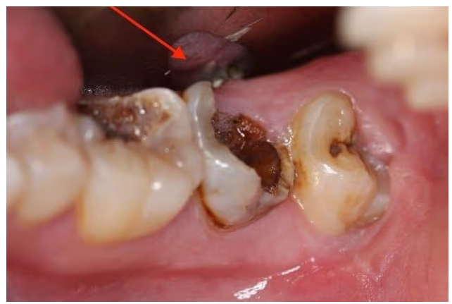Khi nào cần nhổ răng số 7