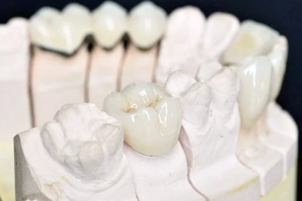 Mão răng sứ là gì? Các loại mão răng sứ