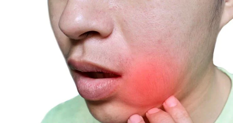 Biến chứng sưng đau sau nhổ răng khôn