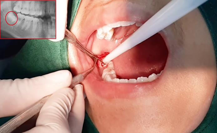 Sự nguy hiểm của răng khôn mọc ngầm
