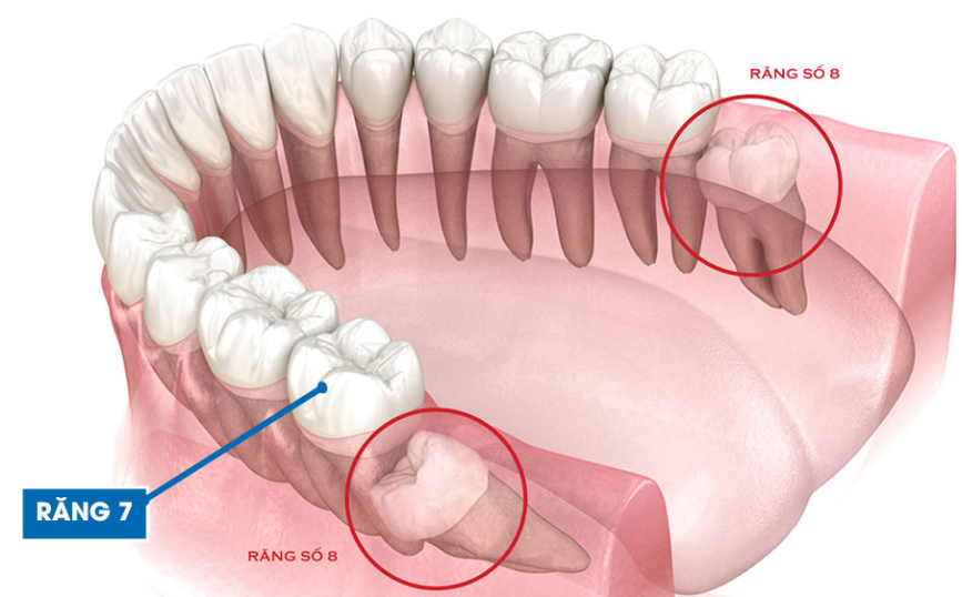 Nhổ răng số 7 có nguy hiểm không