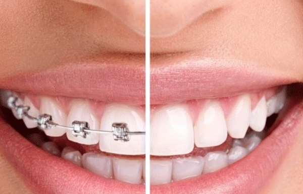 Bọc răng sứ 1-2 chiếc rồi có chỉnh nha tiếp được không?