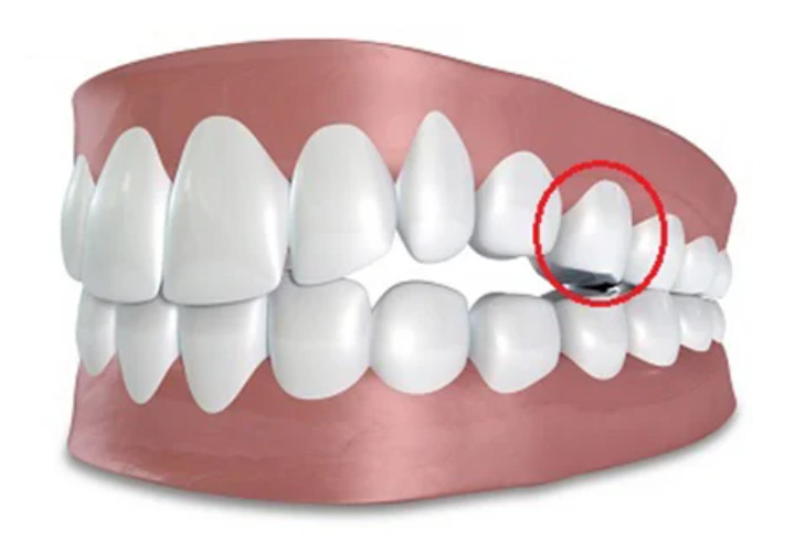 Nhổ răng số 5 hàm trên