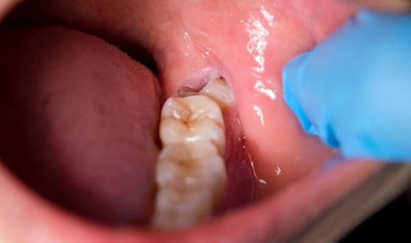 Cấu trúc răng khôn hàm dưới