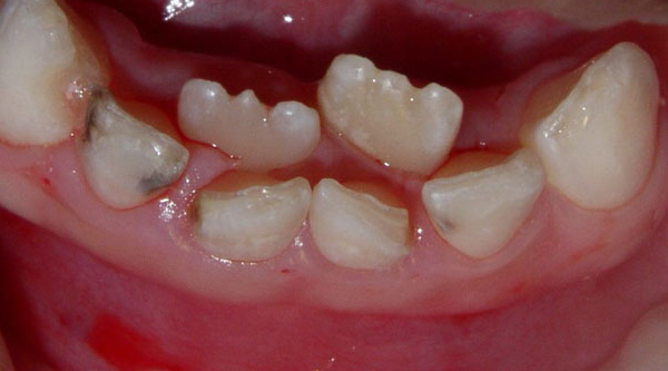 Răng mọc lẫy ở trẻ do đâu, có phải nhổ bỏ không?