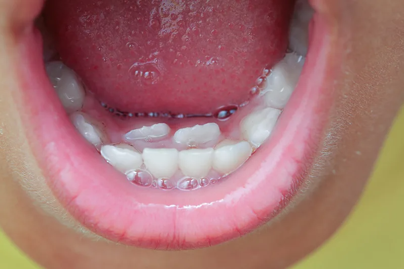 Hiện tượng răng mọc lẫy ở trẻ em