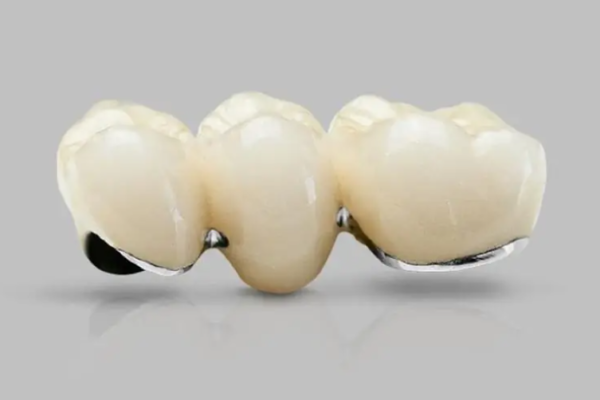 Tìm hiểu về đặc điểm các dòng răng sứ kim loại