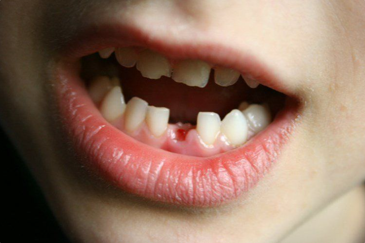 Cách giúp răng sữa rụng tự nhiên