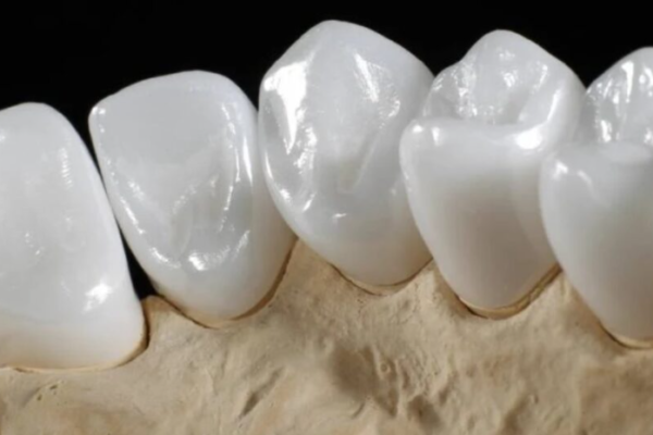 Tìm hiểu toàn bộ đặc điểm và chi phí bọc răng sứ Emax