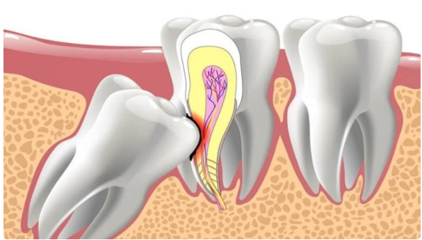 Yếu tố ảnh hưởng đến mức độ đau khi nhổ răng khôn