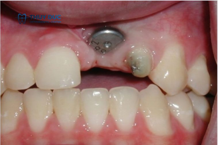 Cấy implant sai vị trí