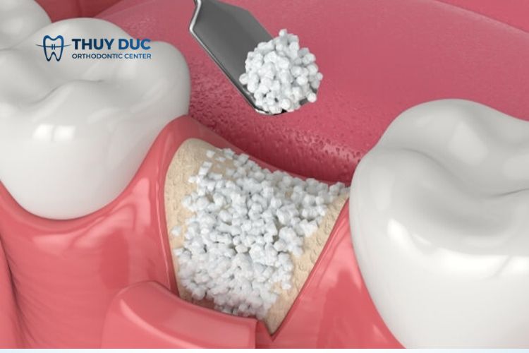 Phẫu thuật ghép xương hàm để cấy ghép implant