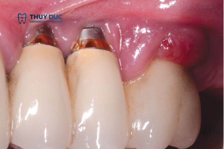 Sưng đau sau khi cấy ghép implant