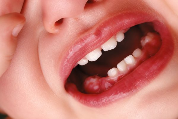 Bé 3 tuổi bị sưng nướu răng – liệu có phải chỉ là viêm lợi thông thường?